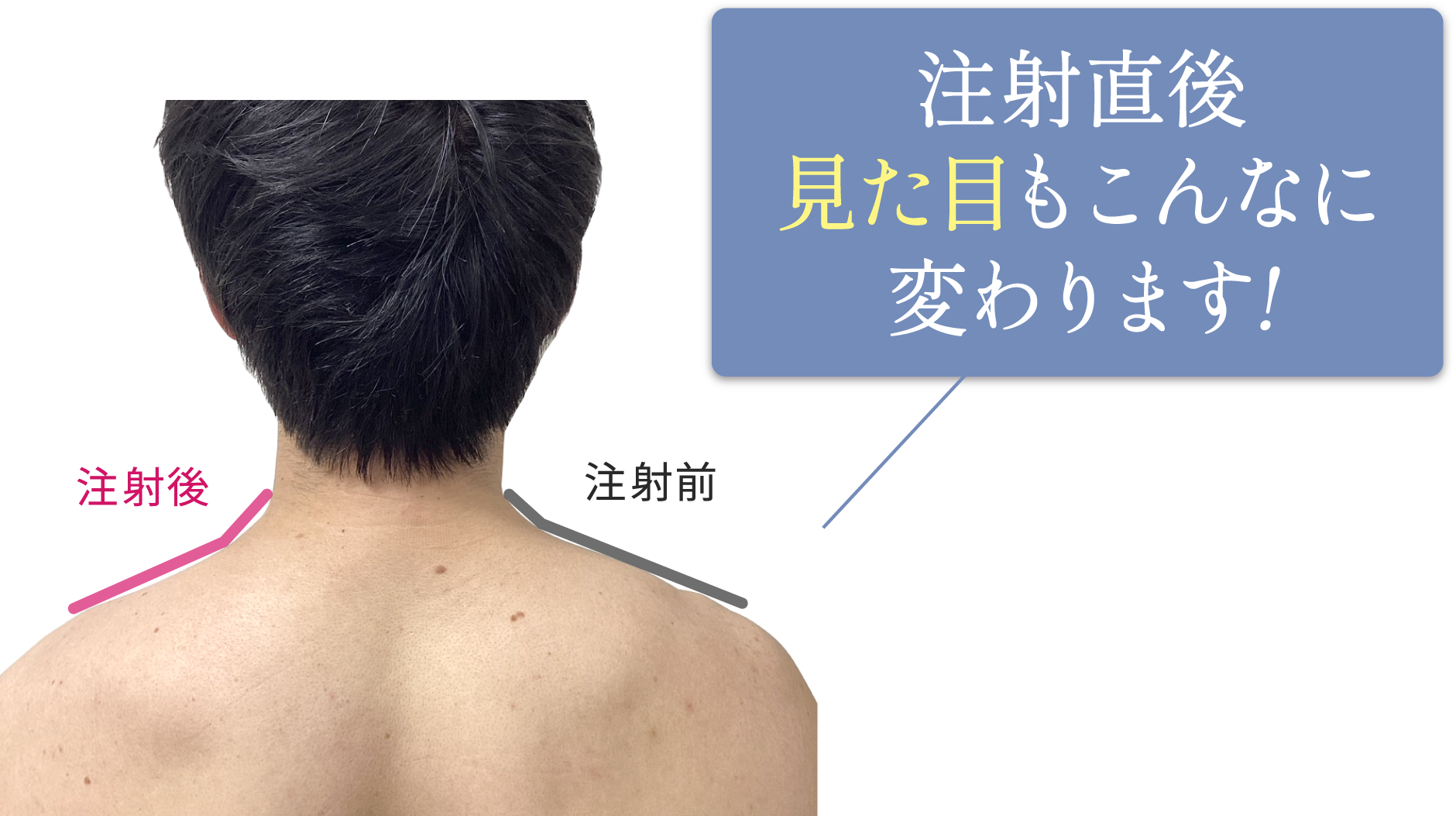 注射直後、見た目がこんなにも変わります！