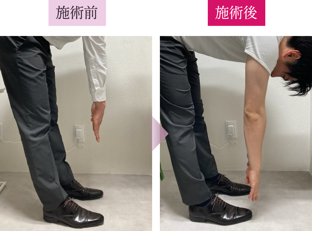 施術前と施術後の写真