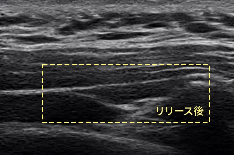 筋膜リリース注射後のエコー写真