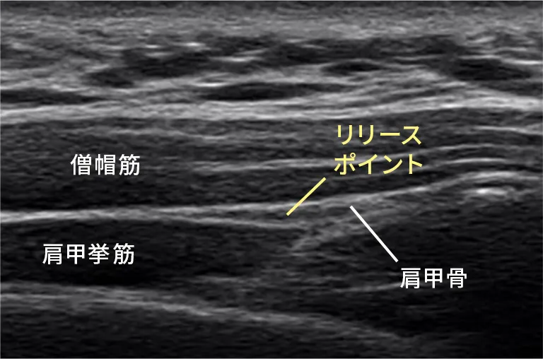 筋膜リリース注射前のエコー写真