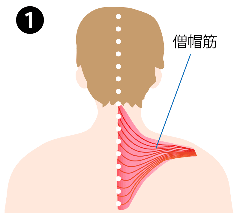 肩こりの要因:僧帽筋の筋膜が癒着し、ヒビや神経のダメージにつながる様子