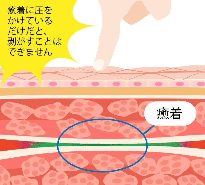 癒着に圧をかけているだけだと、剥がすことはできない様子
