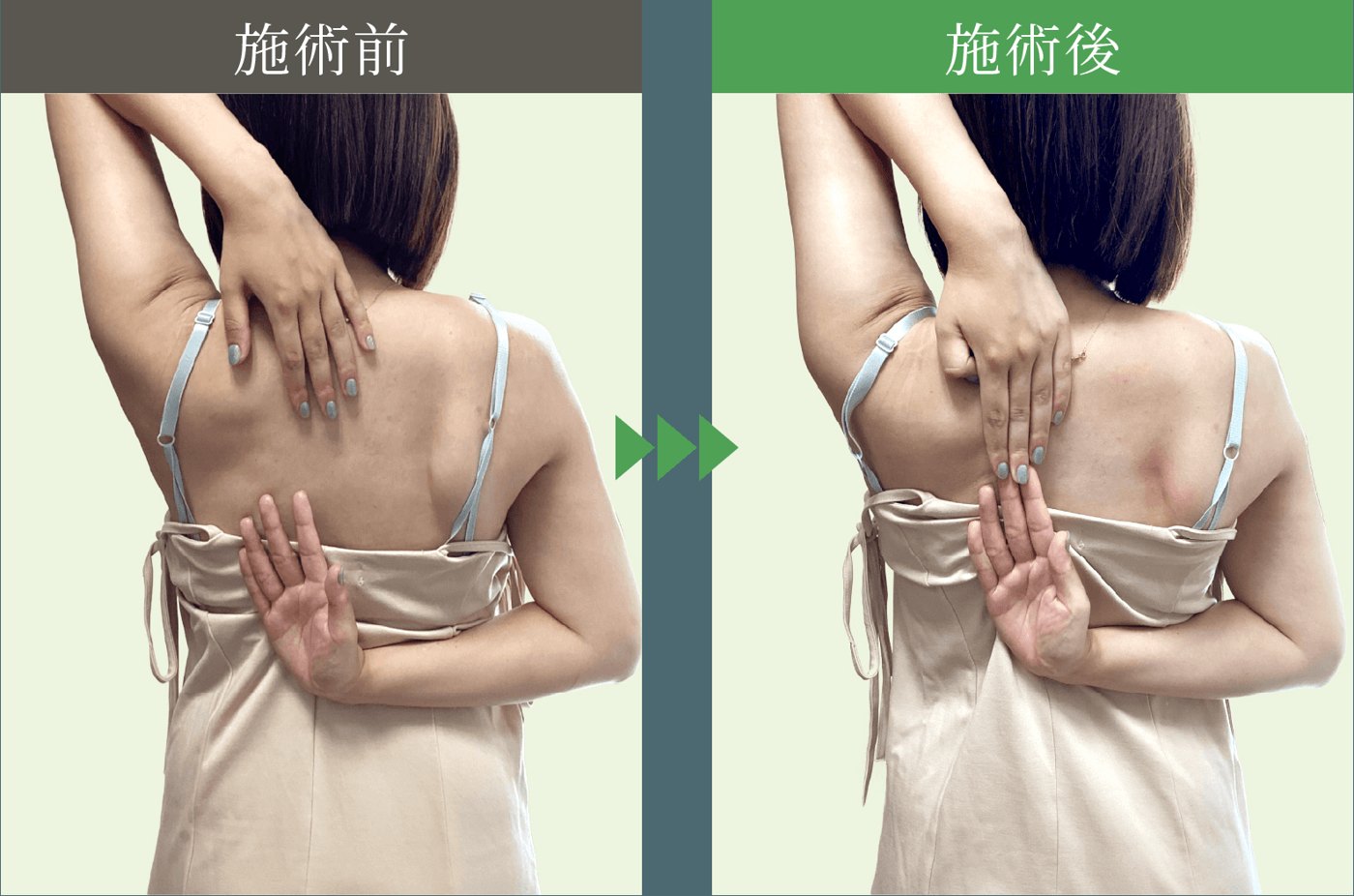 20代女性 施術時間10分の施術前と施術後