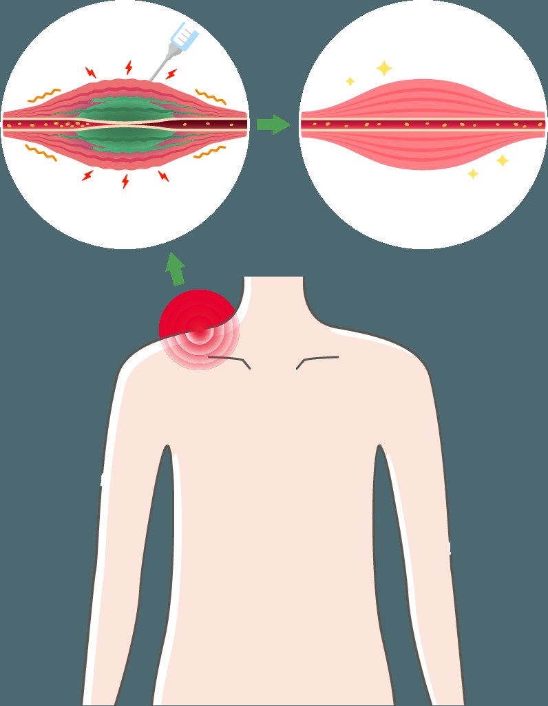 肩こりの原因となる筋膜の癒着と、筋膜リリース注射で癒着が解消されるイメージ
