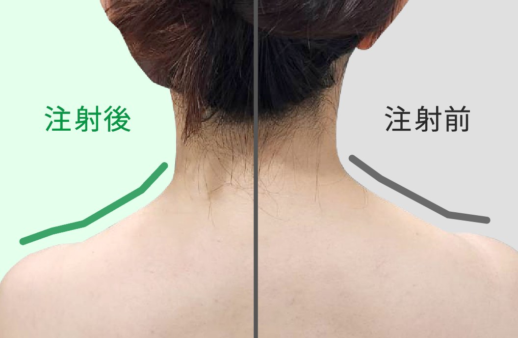 女性の首から肩:左が注射後でラインがなだらか、右が注射前で盛り上がっている