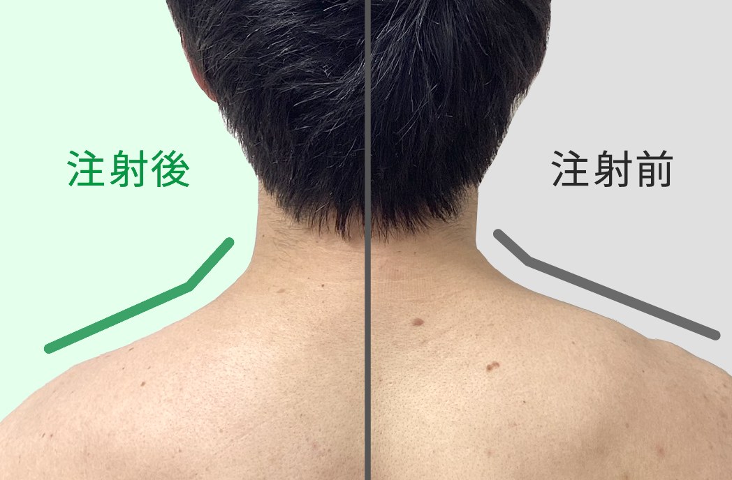 男性の首から肩：左が注射後でラインがなだらか、右が注射前で盛り上がっている