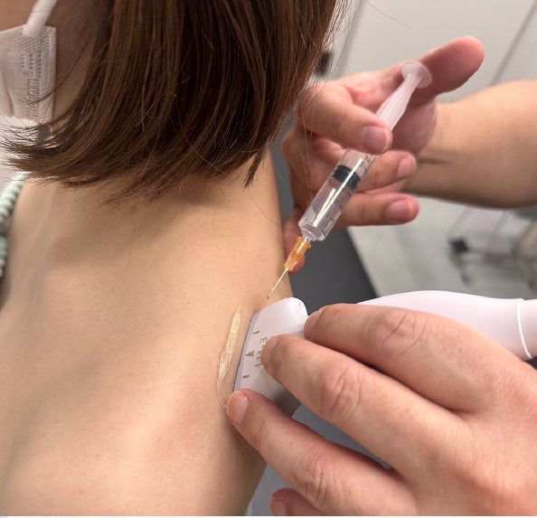 肩の筋膜に直接注射する筋膜リリース注射